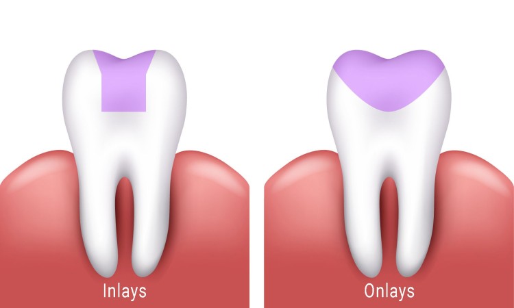 Inlay et onlay : tout savoir sur ces restaurations dentaires modernes